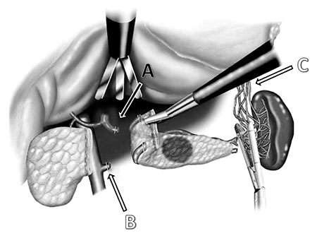 Figur 2: miltbevarende laparoskopisk distal pancreasreseksjon med bevaring av breviskar (Warshaw-metoden). A, arteria lienalis; B, vena lienalis; C, vasa brevia.